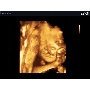 SonoAce R7 3D magzati arc képe